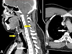Why you shouldn't hold in a sneeze: Man ruptures windpipe while holding his nose