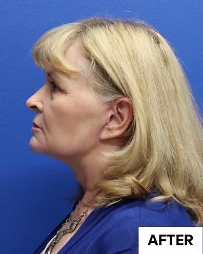 Reno Mini-Facelift with Neck Lift Before and After | Avance Plastic Surgery Institute | Lake Tahoe