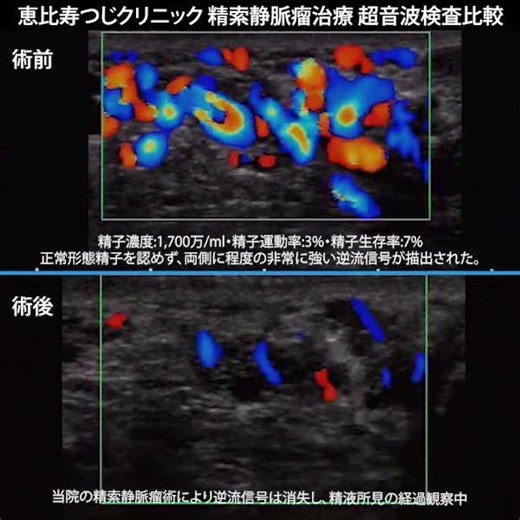精索静脈瘤治療、超音波検査動画（恵比寿つじクリニック超音波検査動画 No.06）