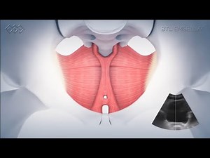 The Emsella Chair for Pelvic Floor Rehab