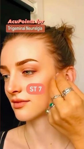 Trigeminal Neuralgia