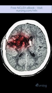 📝 What is Hypovolemic Shock? 🫀 Hypovolemic shock occurs when there’s a significant loss of blood or fluids, leading to inadequate tissue perfusion and oxygenation. 🫶 Be sure to grab your ✨free ✨ NCLEX ebook: visit 👉 nursing.com/nfn 📌 Tips for Nursing Students: ✔️ Early Recognition: Look for signs like low blood pressure, rapid heart rate, and altered mental status. ✔️ Prompt Intervention: Administer IV fluids, control bleeding, and monitor vital signs closely. #NursingStudent #HypovolemicSh