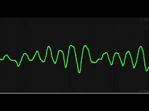 Ventricular Tachycardia Torsades De Pointes