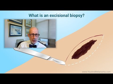 What kind of biopsies are used for melanoma?