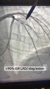 Bifurcation PCI Tips and Tricks: Provisional Technique. Severe In-Stent Restenosis LAD!