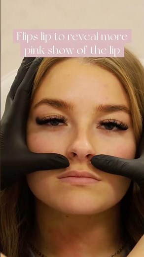 Get a Lip Flip with Botox