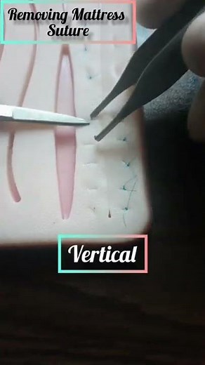 Suture removal। Mattress suture