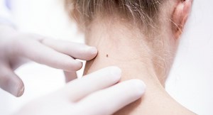 Early detection is key! Everything you need to know about skin checking