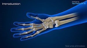 Total Wrist Arthrodesis
