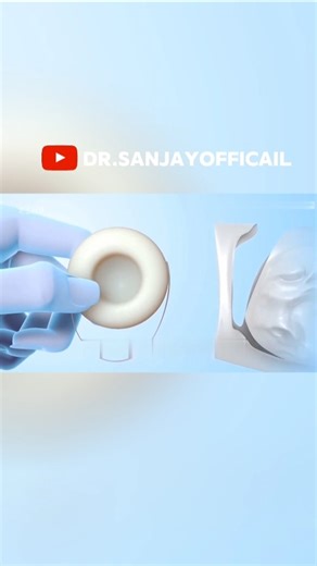 महिलाओं का कंडोम देखा है? ये स्पंज प्रेग्नेंसी रोक देता है!