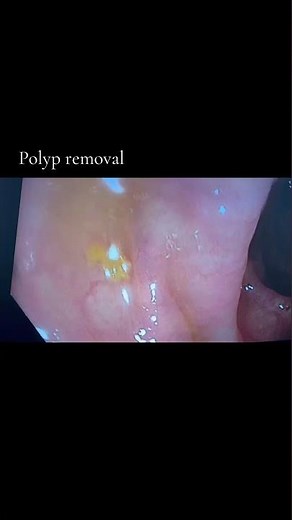 Colon Polyp Removal During Colonoscopy #ColonCancerPrevention #Colonoscopy