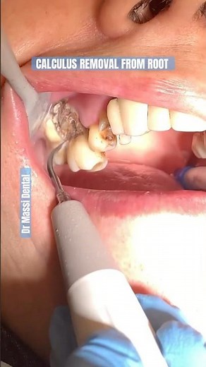 BIG CHUNK OF CALCULUS REMOVAL