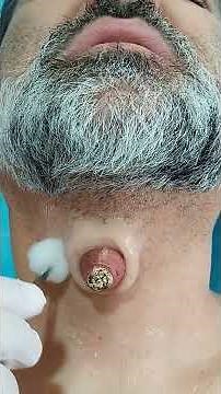 Botfly Maggot Removal