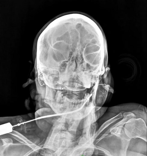 Sialography Video by radiology Dept. of Grant Medical Collage and Hospital, Mumbai.