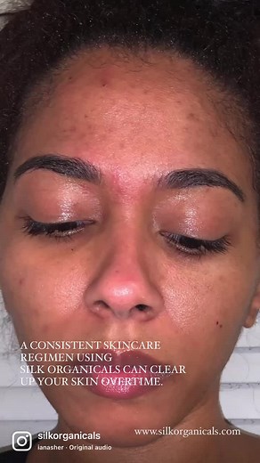 Consistent use of our organic skincare line will clear up your skin in no time! Real results won’t show up overnight but if you stick to your routine daily you’ll achieve real, visible results ✨ • Shop skincare products that CARE, exclusively at www.Silkorganicals.com. #skincare #skin #acnetreatment