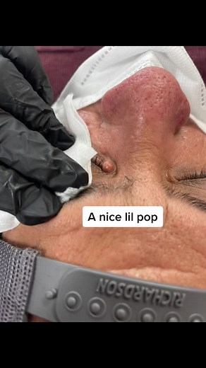 Poppin Monday ! #cyst #poppin #popaholic #cystpopping #skin #dermatology #pa #popping #pimplepopper #pop #satisfying #ouch