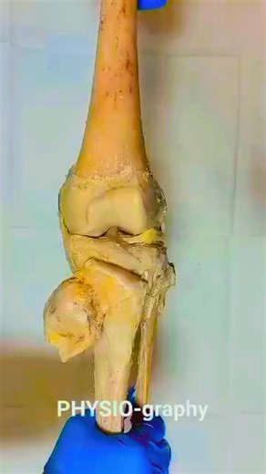 #examination#Bones#Involved 1. *Femur* (thigh bone) 2. *Tibia* (shin bone) 3. *Fibula* (outer lower leg bone) Examination Techniques 1. *Inspection*: Observe for deformities, swelling, or bruising. 2. *Palpation*: Feel for tenderness, warmth, or crepitus (grinding sensation). 3. *Range of motion*: Assess knee and ankle mobility. Common Conditions 1. *Fractures*: Breaks in the bones. 2. *Osteoarthritis*: Joint degeneration. 3. *Phobias*: Psychological fear or anxiety (not a bone condition). Phobi