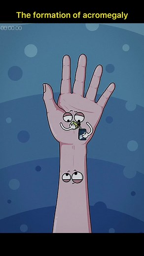 Understanding Acromegaly: How it Affects the Formation of the Palm