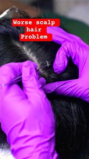 Asmr scalp psoriasis #scalppsoriasis #asmrscalpcheck #triggersforsleep ‪@MadPASMR‬