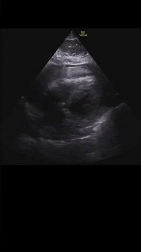 Hemopericardium #pocus #echo #echofirst #emergencymedicine #criticalcaremedicine
