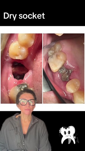 How to Prevent Dry Socket After Tooth Extraction