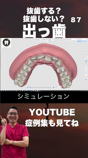 出っ歯、八重歯 口ゴボ ワイヤー矯正 安い費用50万円〜鈴木歯科医院 埼玉県さいたま市大宮 矯正歯科医院 マウスピース矯正 茨城県東京千葉からも受付