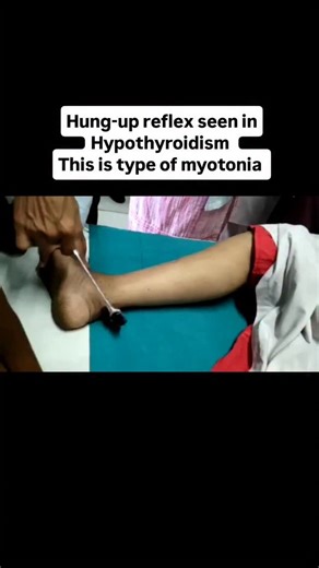 Dr. Neuro on Instagram: "Hung-up Reflex Hung-up reflex refers to an abnormally prolonged relaxation phase of a deep tendon reflex (DTR) after its contraction. Key Features Reflex is elicited normally Contraction occurs, but Relaxation is delayed / slow The limb appears to remain “hung-up” before returning to rest. Most Common Cause ✅ Hypothyroidism This is the classical association and a favorite exam point. Pathophysiology (Why it happens?) Thyroid hormone deficiency leads to: ↓ Calcium reuptak