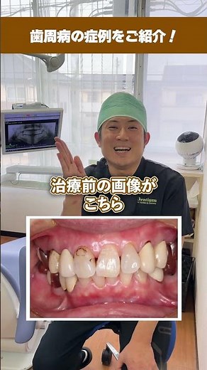 【歯周病のリアル】歯茎から血が出る・腫れやすい悩みを一発解決！歯医者さんが実際の改善症例をビフォーアフターで解説！#shorts