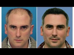 Hair Transplant Mind blowing results