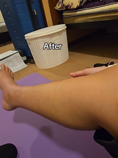Effective Physiotherapy for Tibial Fracture Recovery