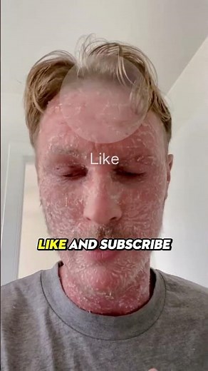 Why Does Skin Peel?