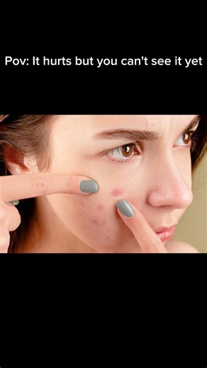 The "blind pimple" survival guide. 🧬 #skincaretips