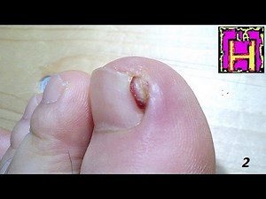 Unghie incarnite. Prevenire e curare le unghie incarnite.