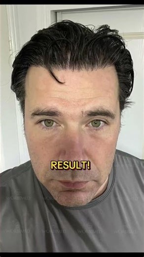 Hair Transplant Results | Before and After #hairtransplantturkey #hairlosstreatment
