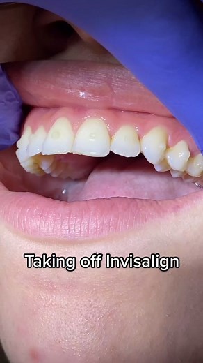 Removing Invisalign attachments! Look at how beautiful this smile is after Invisalign😁 #dentist #invisalign #victoria #fyp #foryou #intothethickofit