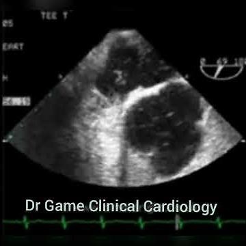 PFO - Patent Foramen Oval - Bubble study - Contrast - TEE - Echo Clip