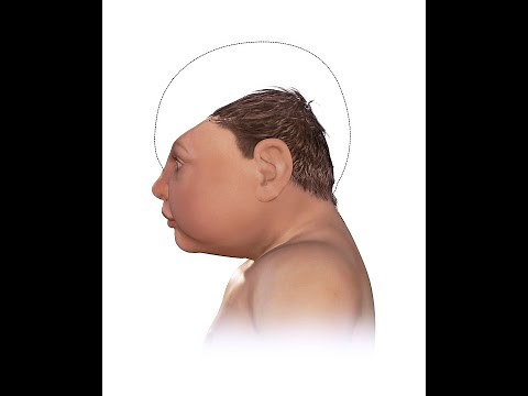 What is Microcephaly? Causes, Symptoms, Treatment