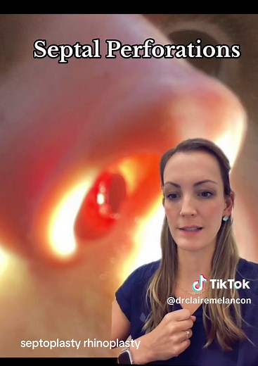 drclairemelancon (@drclairemelancon) - Understanding Septal Perforations: Causes, Symptoms, and Repair