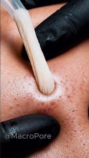 COMEDONE EXTRACTION — You Won’t Expect This 👀