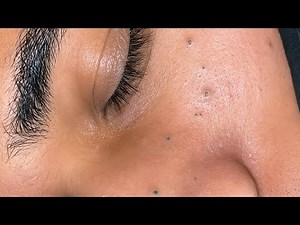 [ASMR] Deep Pore Facial Care Routine for Blackheads Removal