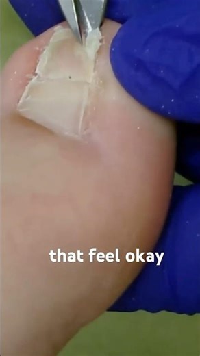 Foot Nurse Trims Clubbed Nail