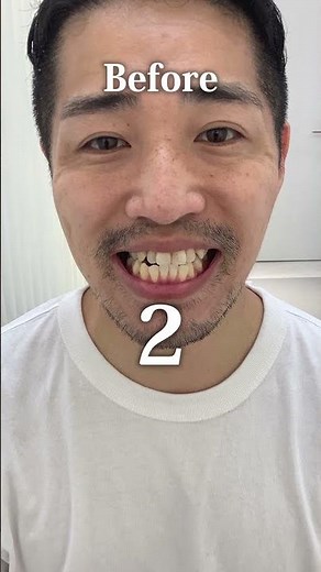 【マウスピース矯正 Oh my teeth】出っ歯をマウスピースで矯正 #shorts #マウスピース矯正 #歯科矯正