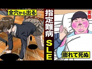 【実態】全穴から排出物…指定難病SLE。最後は膨れて死ぬ。