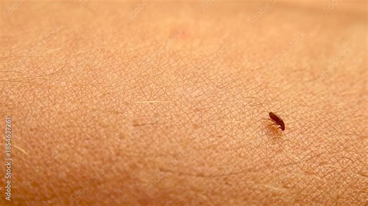 Macro Flea walking on human skin searching for a blood feeding site, showing parasitic behavior, skin health risks and disease transmission. For medical education and healthcare awareness. Parasites.