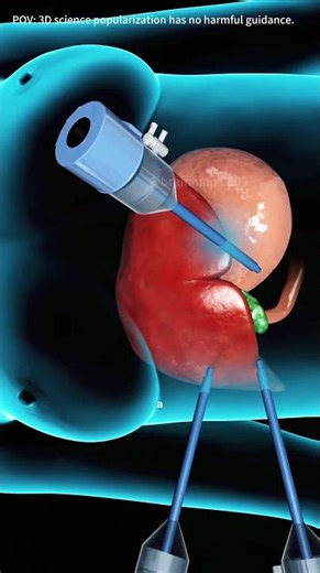 Gallbladder removal surgery#medical #medical3d #medical3danimation #urine #gallbladder