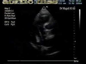 Type A aortic dissection : TTE