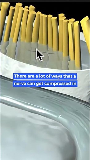 Nerves get compressed in many ways