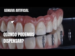 A sua prótese sobre implantes precisa de gengiva artificial? Dr Douglas Lima responde.