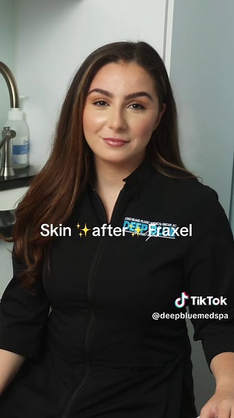 Fraxel Laser Skin Resurfacing: Before and After Results