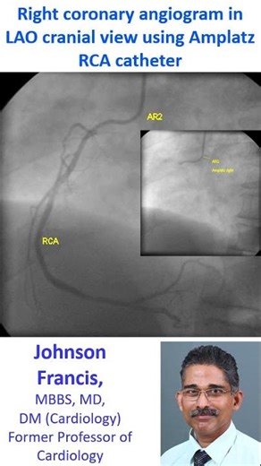 Right coronary angiogram in LAO cranial view using Amplatz RCA catheter